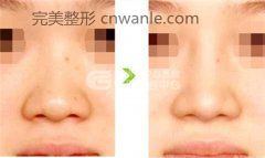 荆州鼻尖整形手术具体有哪些方法呢？