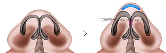 鼻尖<a href='/tag_zhengxingshoushu5.html'>整形手术</a>