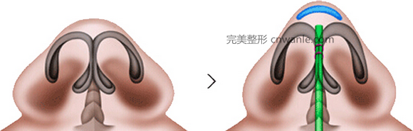 <a href='/tag_bijianzhengxingshou2.html'>鼻尖整形手术</a>